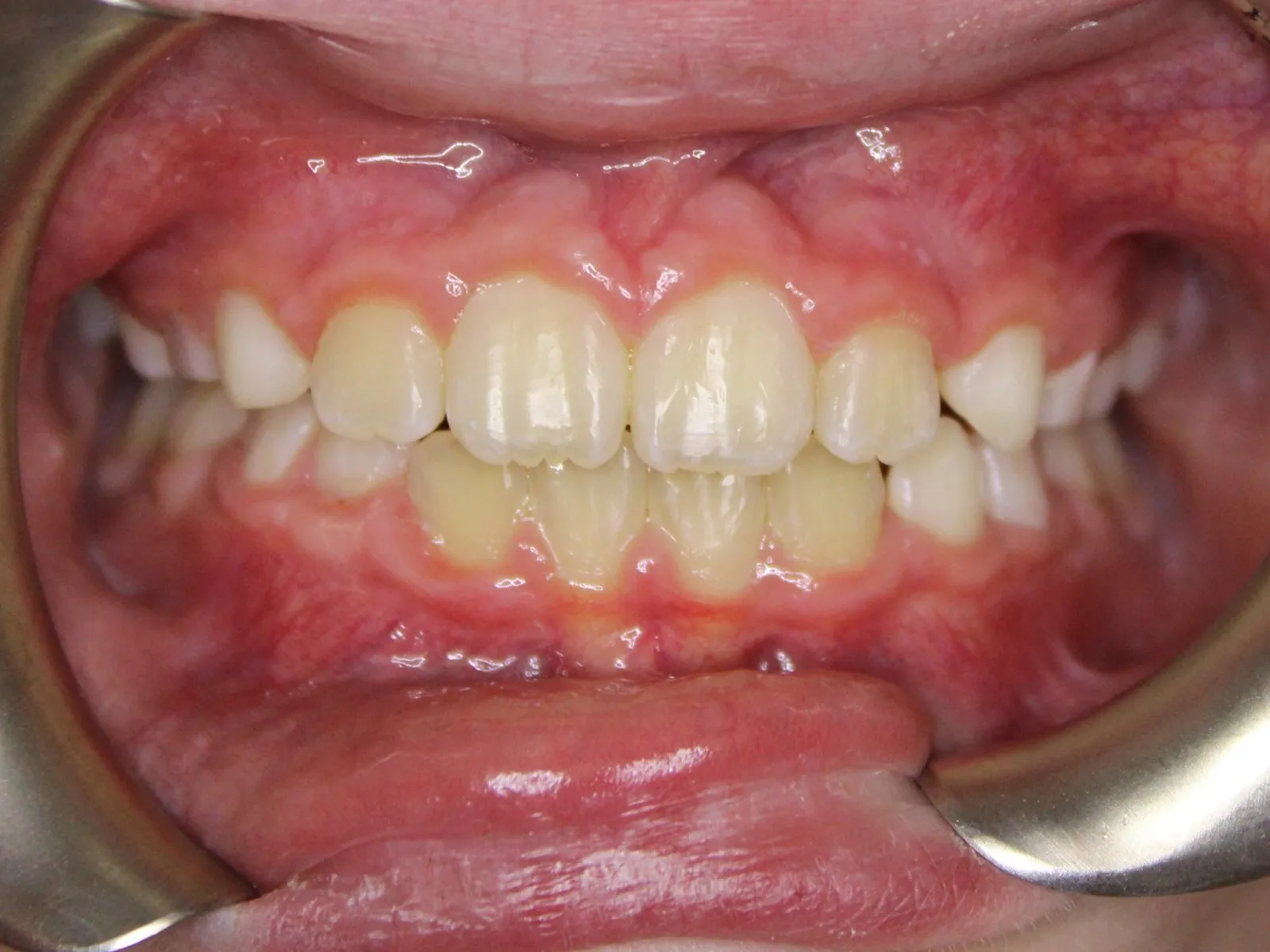 After: Crossbite, Crowding, Overbite