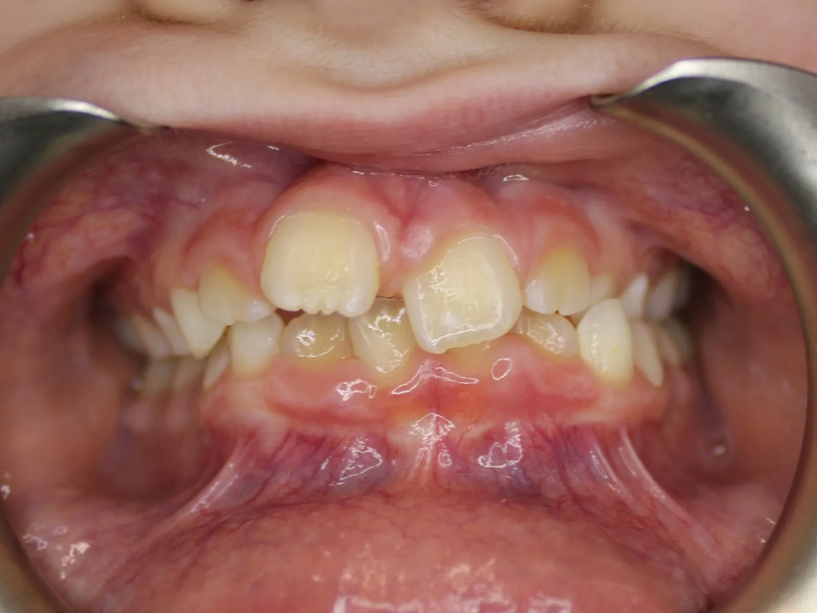Before: Crossbite, Crowding, Overbite